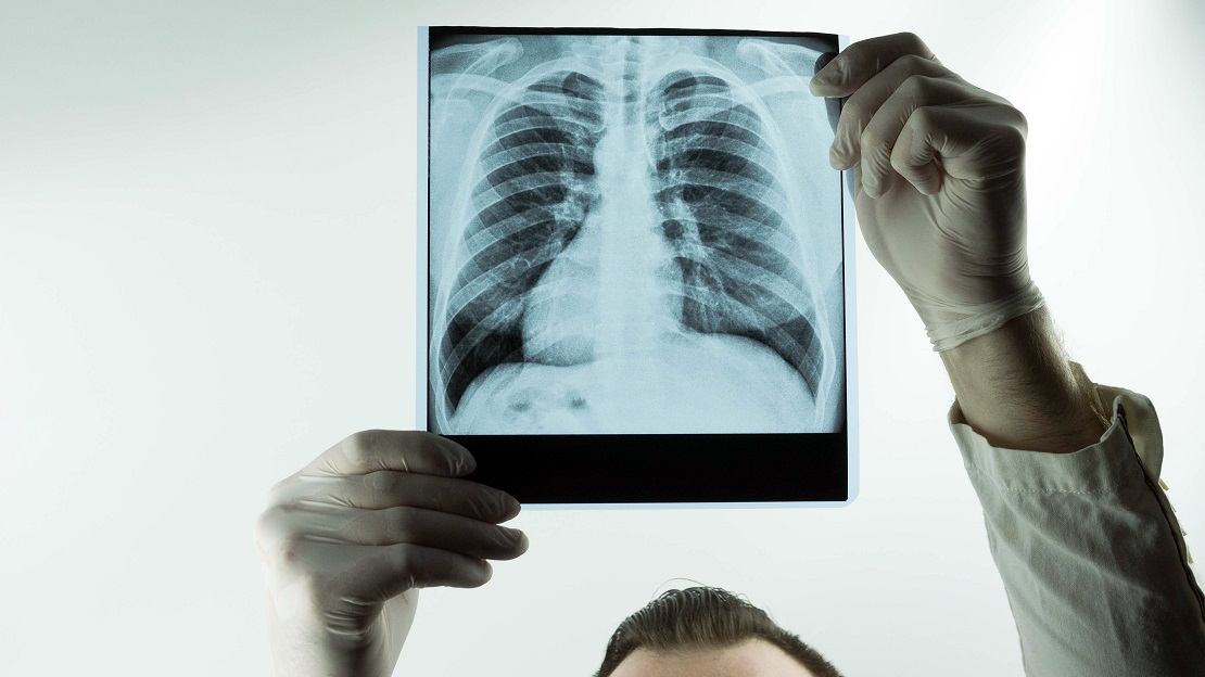 Powikłania oddechowe po COVID – jak leczyć?